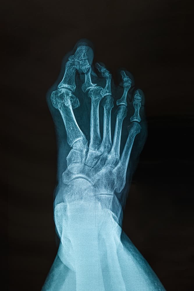 Bunion