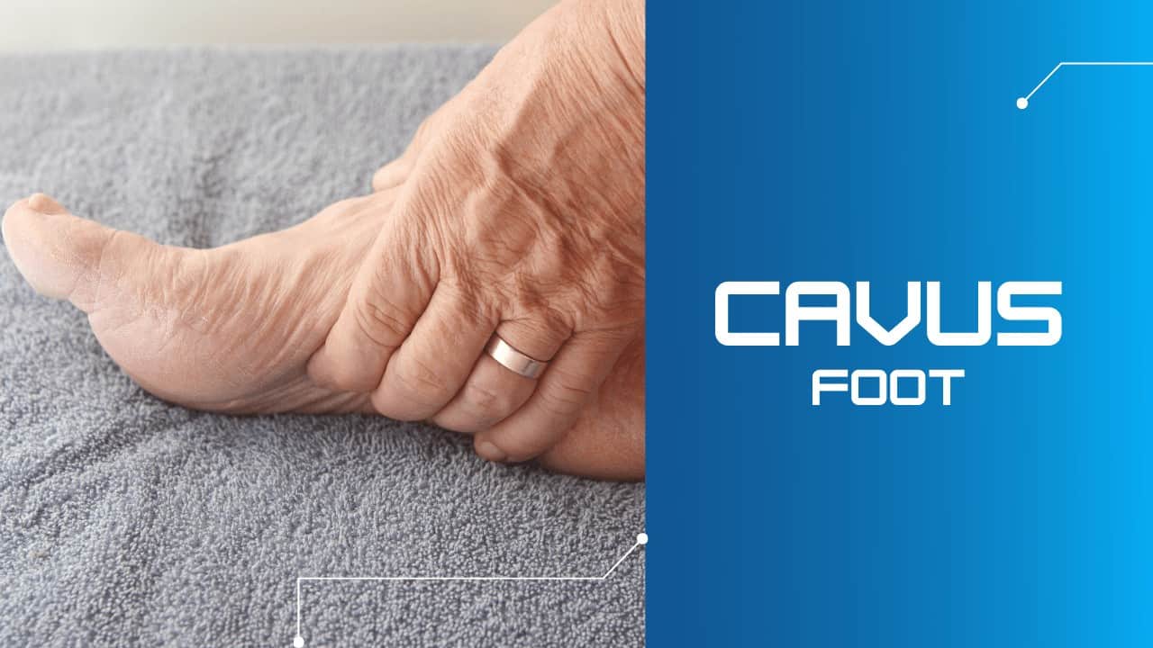 Cavus Foot Richmond VA