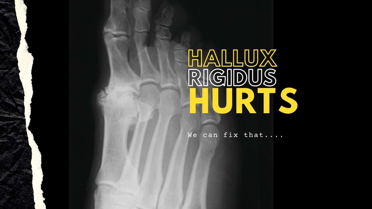 Hallux Rigidus Pain