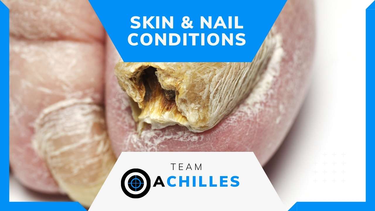 Foot Skin & Nail Conditions