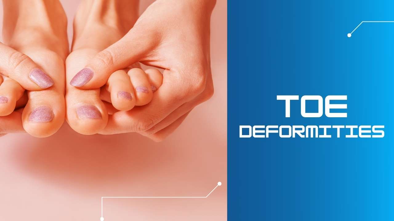 Toe Deformities