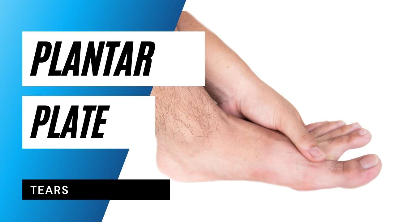 Plantar Plate Tear