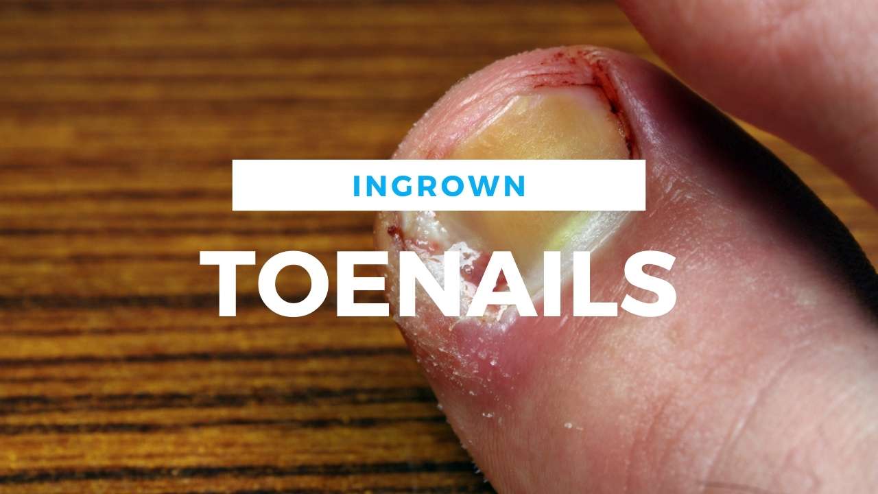 Painful Ingrown Toenails