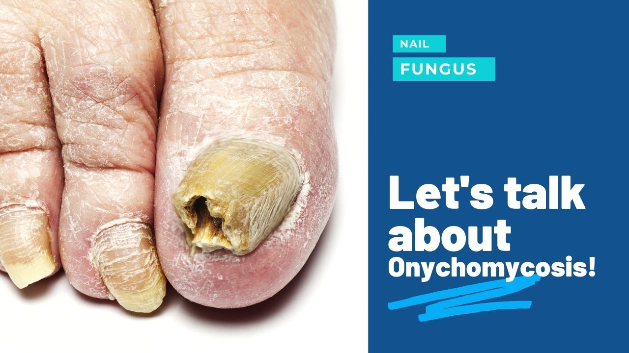 Fungal Toenail Treatments in Richmond VA