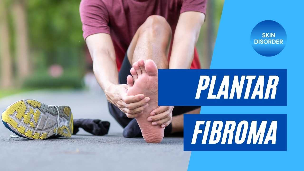 Plantar Fibroma Richmond VA