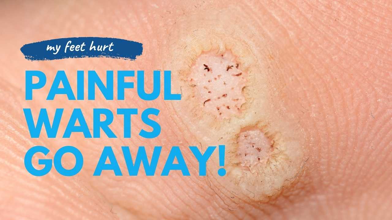 Plantar Wart Treatment